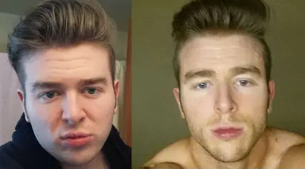 face fat