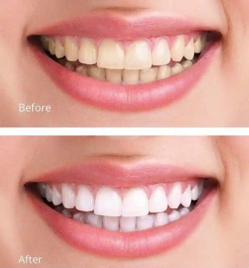 tooth smile