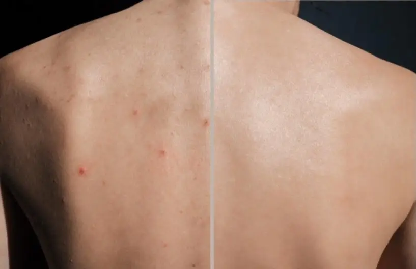 back acne