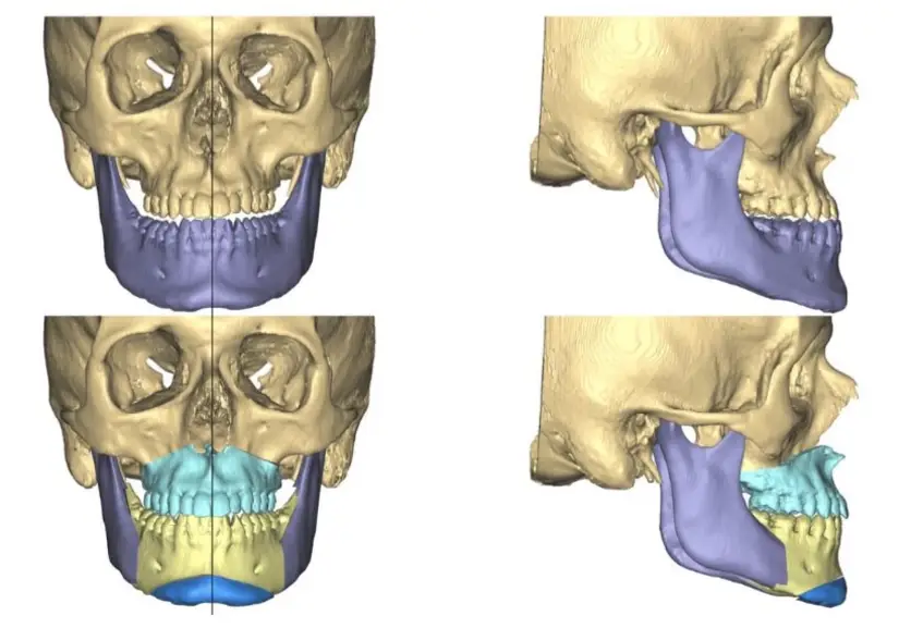 looksmax surgery