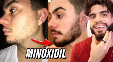 minoxidil