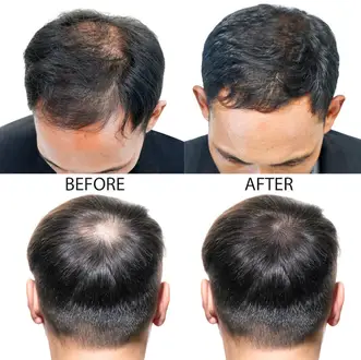 minoxidil