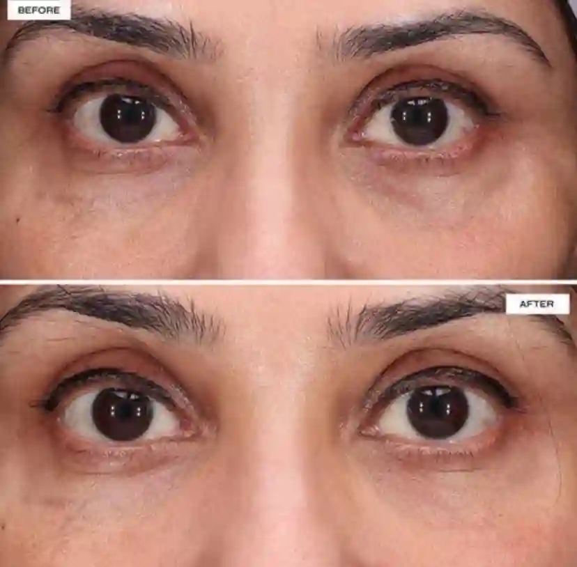 dark circles